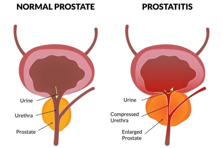 Prostate cancer (overview, symptoms, causes, stages