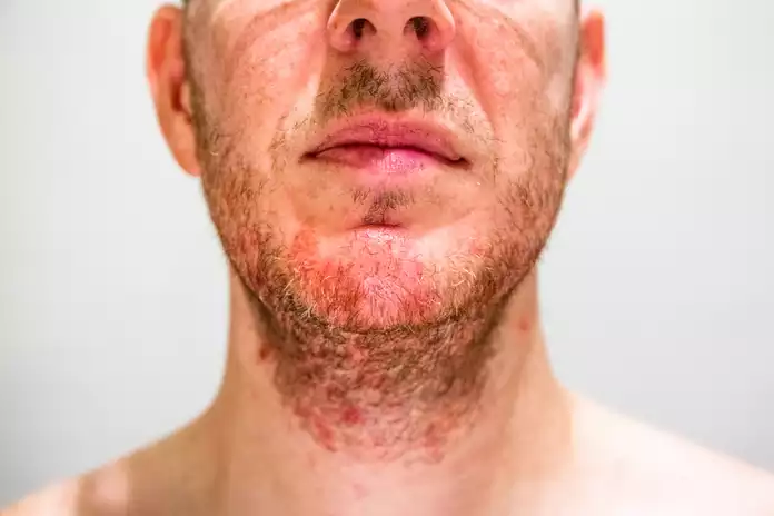 Are There Different Types of Folliculitis?