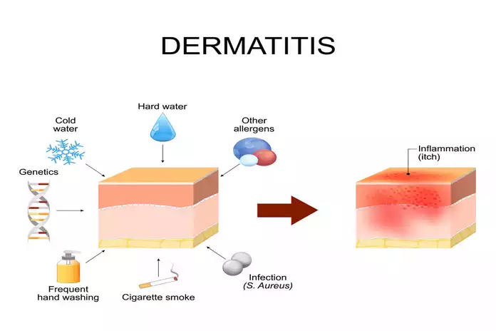 What causes Atopic Dermatitis?
