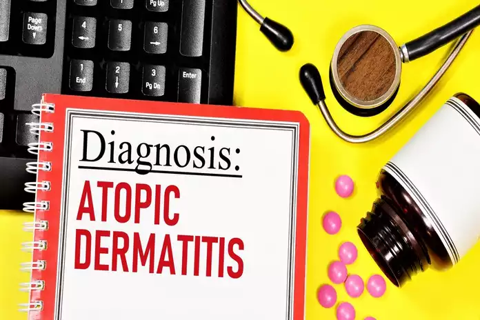 Atopic Dermatitis Diagnosis