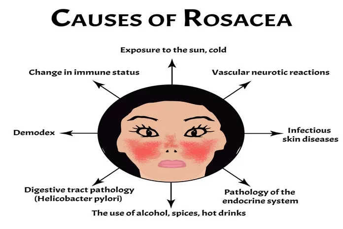 Common Causes of Rosacea
