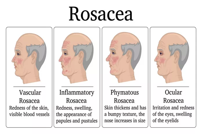 Different Types Of Rosacea