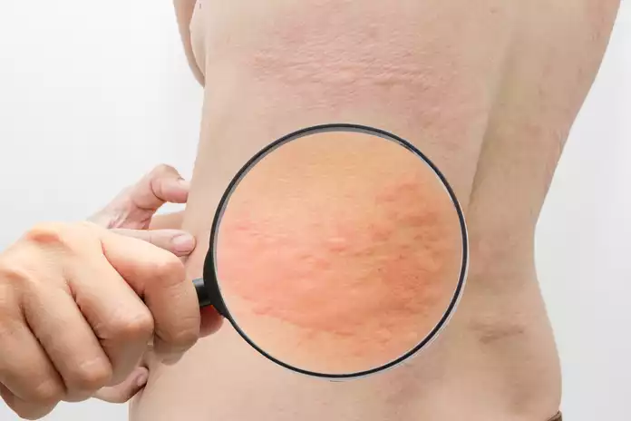 How To Diagnose Urticaria (Hives)