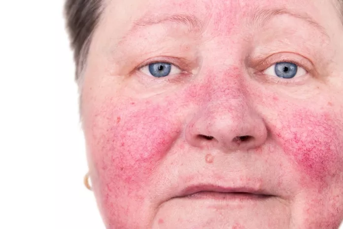 What Is The Prognosis For Rosacea?