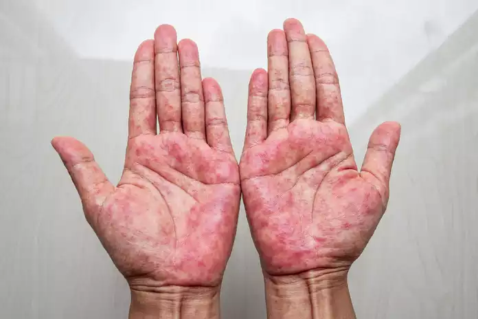 The 6 Most Common Types of Atopic Dermatitis