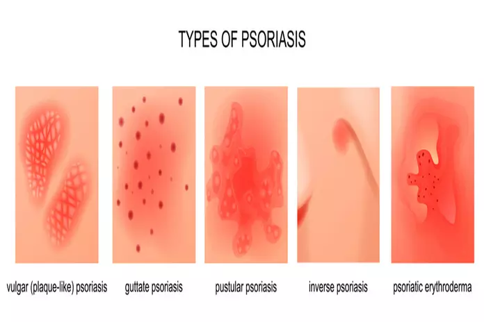 Types Of Psoriasis Can You Have More Than One?