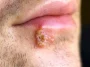 What Are Cold Sores