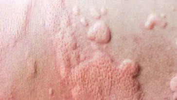 What Are Different Types Of Hives (Urticaria)