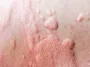 What Are Different Types Of Hives (Urticaria)
