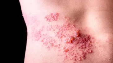 What Are the Stages of Shingles