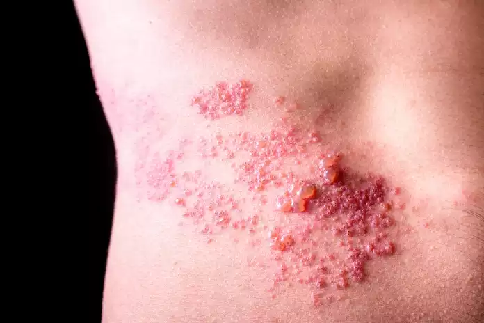 What Are the Stages of Shingles
