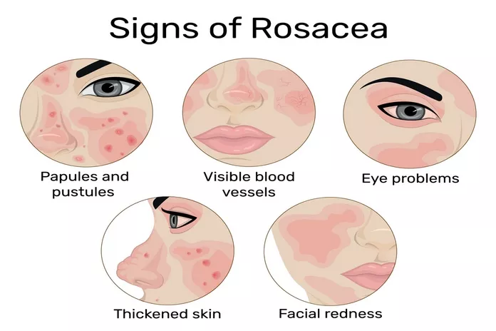 What Is Rosacea Symptoms?