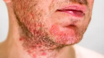 What is Folliculitis ?