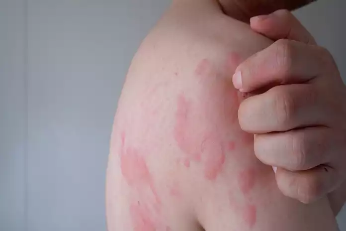 What is Urticaria?