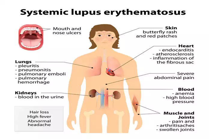 10 Early Symptoms of Lupus How to Identify Them