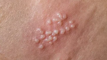 Are Blisters Contagious?