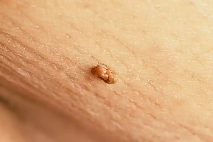 Are Skin Tags Contagious?