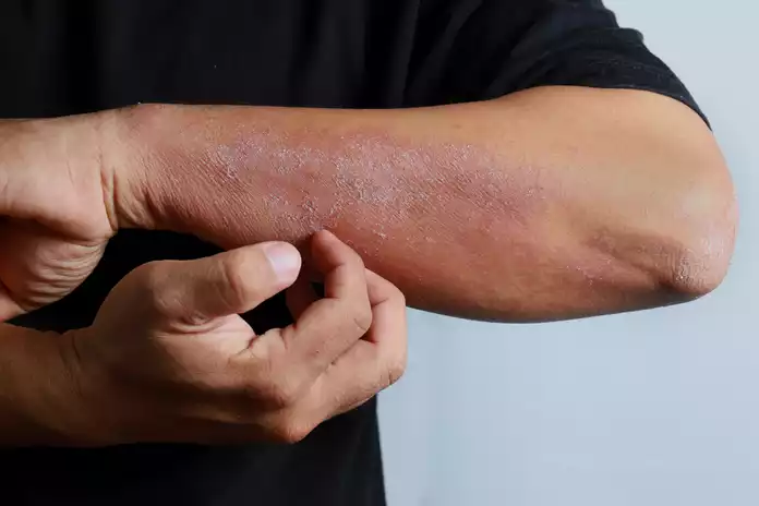 Dry skin Signs and Symptoms