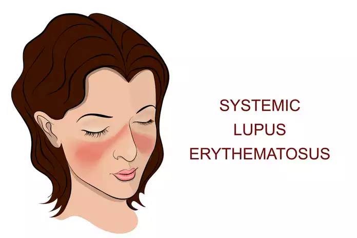 Is Lupus Contagious?