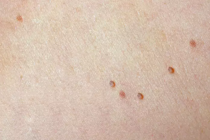Living With Skin Tags