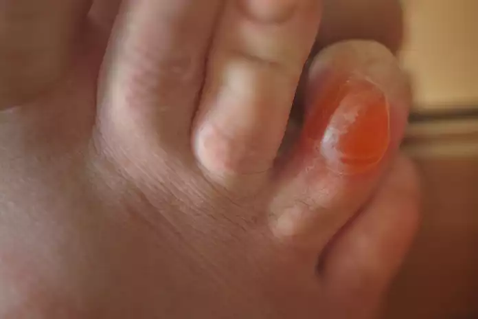 Types of Blisters