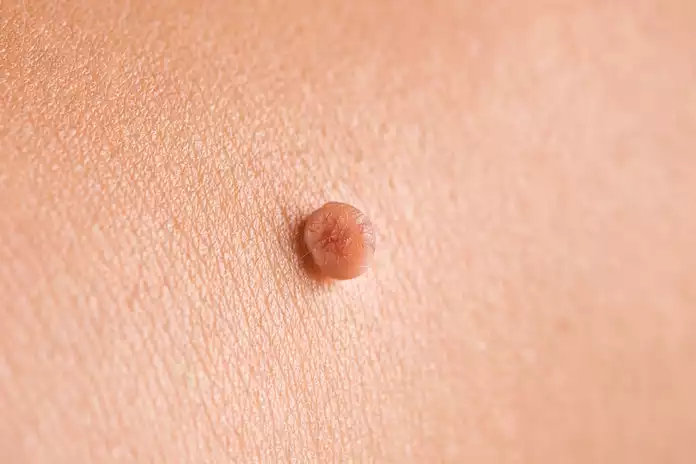 Understanding The Different Types Of Skin Tags