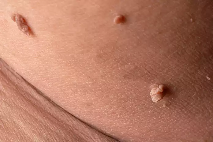 What Are Skin Tags?