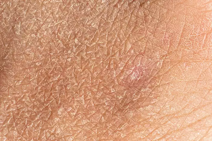 What Dry Skin Type Do I Have?