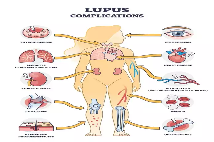 What Is The Most Common Complication of Lupus