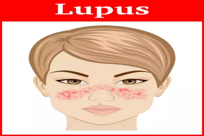 What is Lupus?